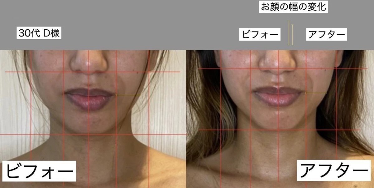 フェイシャルのビフォーアフター写真